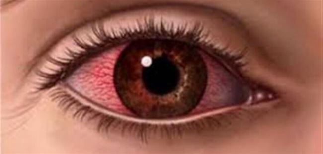 كيفية علآج ألم العين