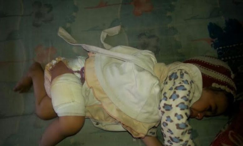 اصابة طفلة في ظفار جراء اشتباكات وقصف عنيف  لمليشيات الحوثي