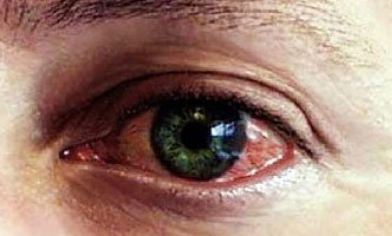 4 وصفات طبيعية لمعالجة احمرار وحكة العين