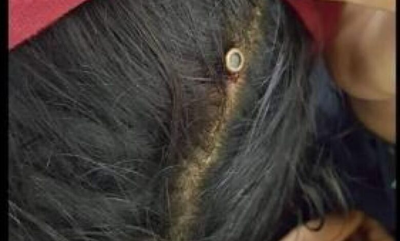بالصورة : رصاصة راجع تنغرس في رأس طفلة صغيرة بصنعاء