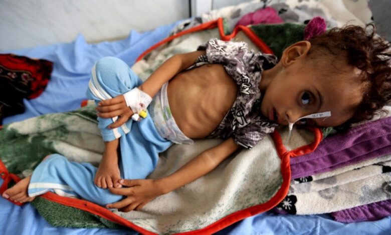الأغذية العالمي: اليمن يسجل أعلى مستويات سوء التغذية بين الأطفال في العالم (Translated to English )