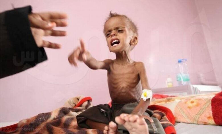 اليونيسيف تحذر من سوء التغذية باليمن