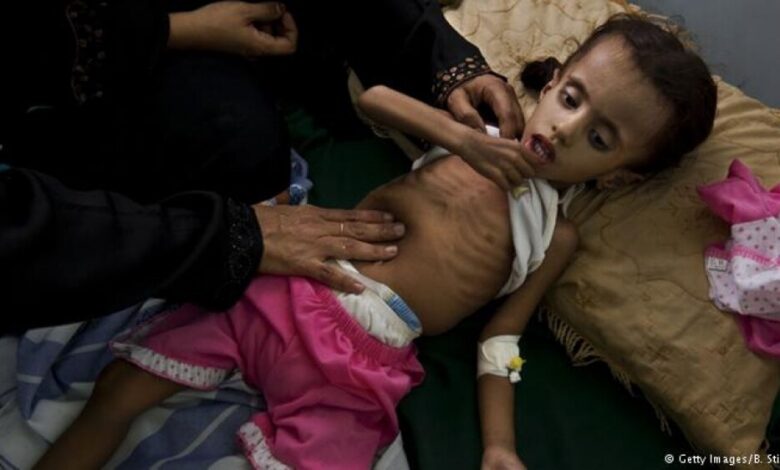 تفاقم معدلات سوء التغذية بين أطفال اليمن