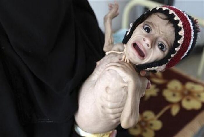 تحذيرات من وقوع أسوأ مجاعة على مستوى العالم في اليمن
